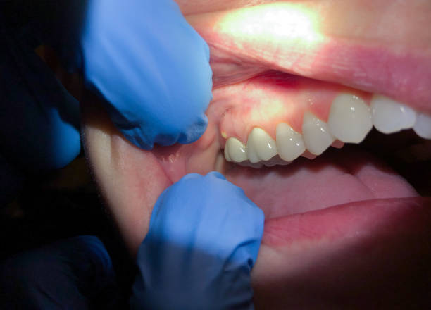 Best Emergency Tooth Extraction in Lahoma City, OK
